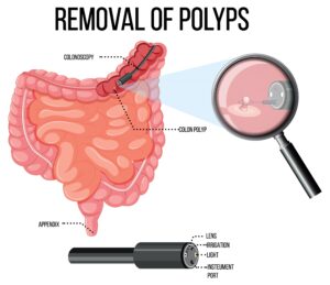 Colon polyps treatment